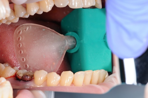 Аспирационно ретракционная система Freestom solid размер L